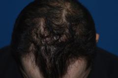 After mid scalp hair restoration