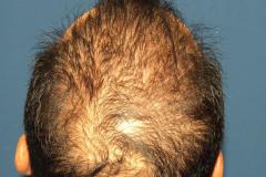 Before crown hair restoration