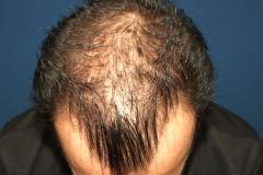 Before mid scalp hair restoration