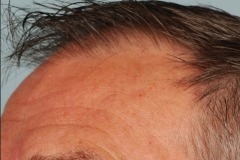Before hair restoration profile
