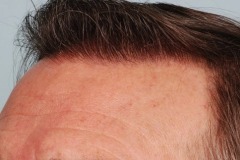 after hair restoration profile