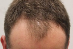 Before hair restoration crown