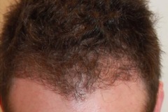 after hair restoration crown