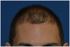 Before hair restoration top