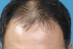 Before hair restoration top crown