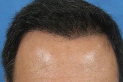 after hair restoration top crown