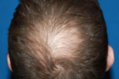 Before hair restoration mid-scalp