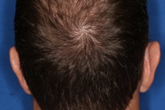 after hair restoration mid-scalp