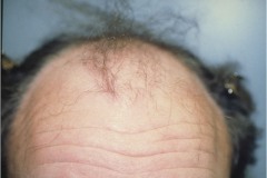 before hair restoration crown
