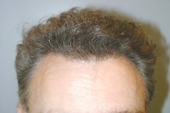 After hair restoration crown