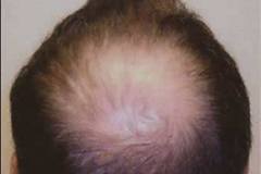 Before  hair restoration mid-scalp