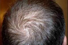 After  hair restoration mid-scalp