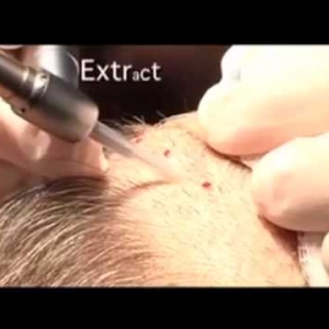 A man getting NeoGraft