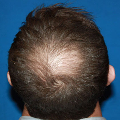 Before Hair Restoration Surgery Set 2