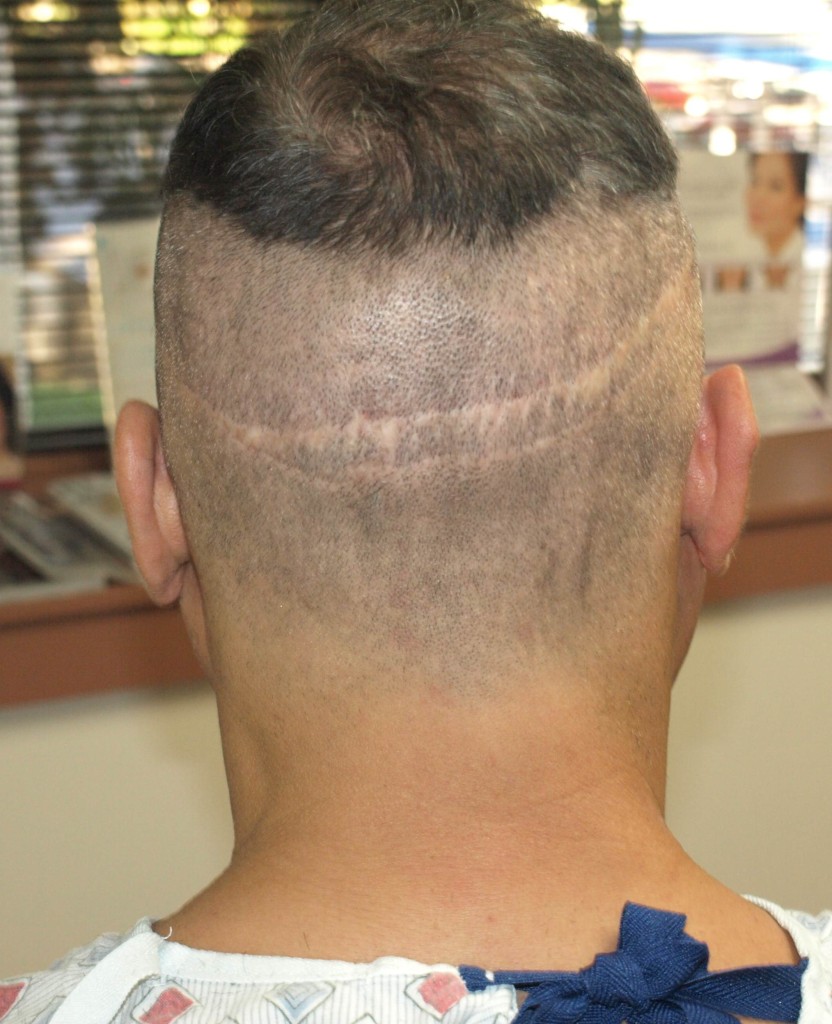 patient showing the back of his head, two previous Strip hair transplants scars from the procedures